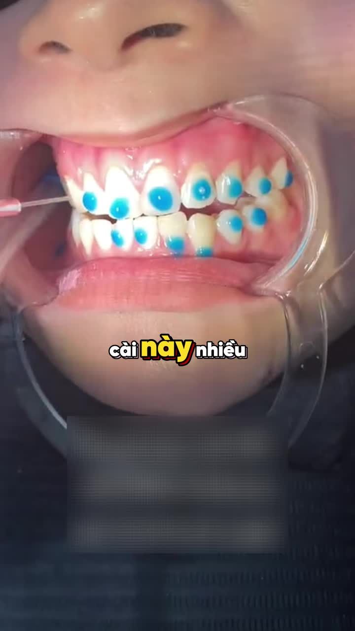 GẮN MẮC CÀI CÓ ĐAU KHÔNG?