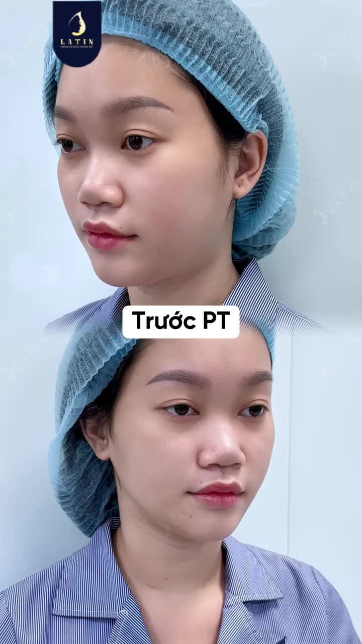 FOMO THAY ĐỔI DÁNG MŨI THEO BẠN LIỆU CÓ ĐẸP ??