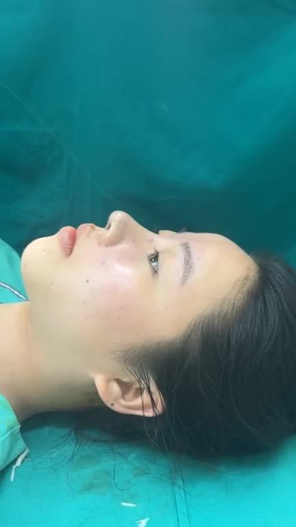NÂNG MŨI CẤU TRÚC – DÁNG ĐẸP TỰ NHIÊN NGAY SAU PHẪU THUẬT