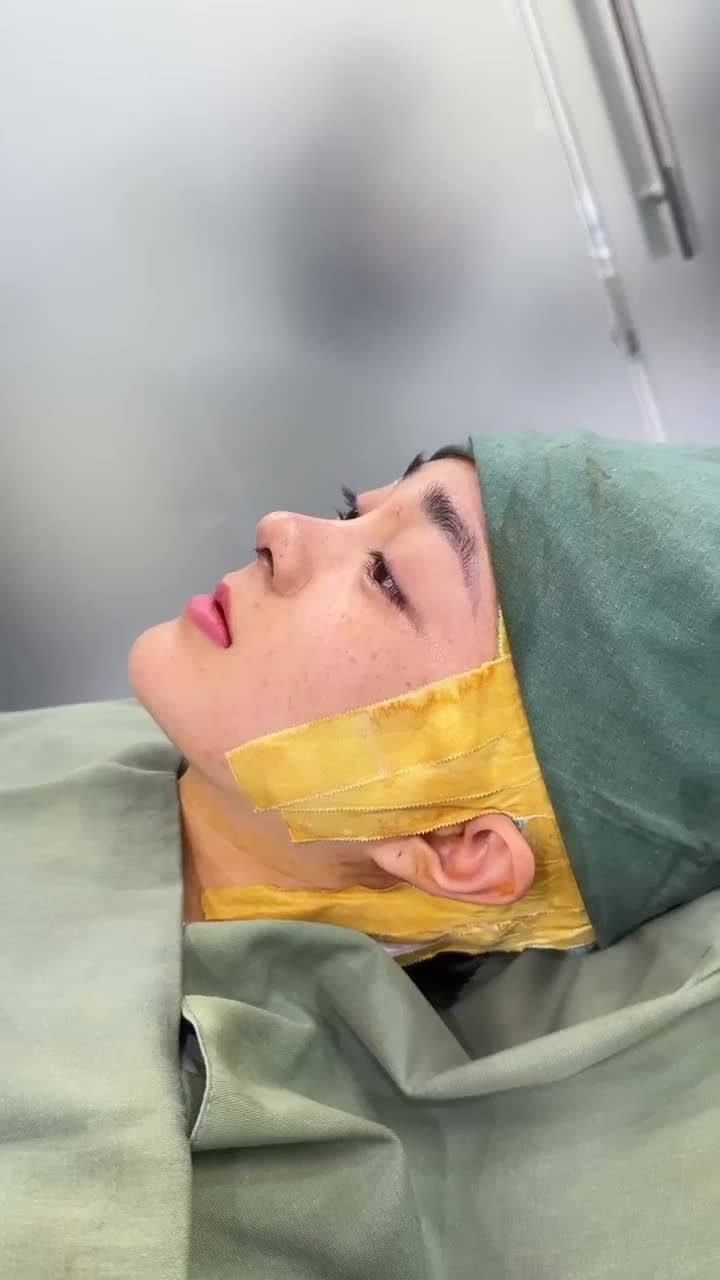 TRẢ KẾT QUẢ NÂNG MŨI CẤU TRÚC DR. HOẠT KH: THANH THỦY (ĐÀI LOAN)