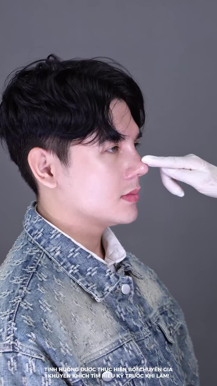 SAU 2 NĂM NÂNG MŨI BỌC SỤN, ANH KHÁCH QUYẾT ĐỊNH "NÂNG CẤP" LÊN MŨI CẤU TRÚC