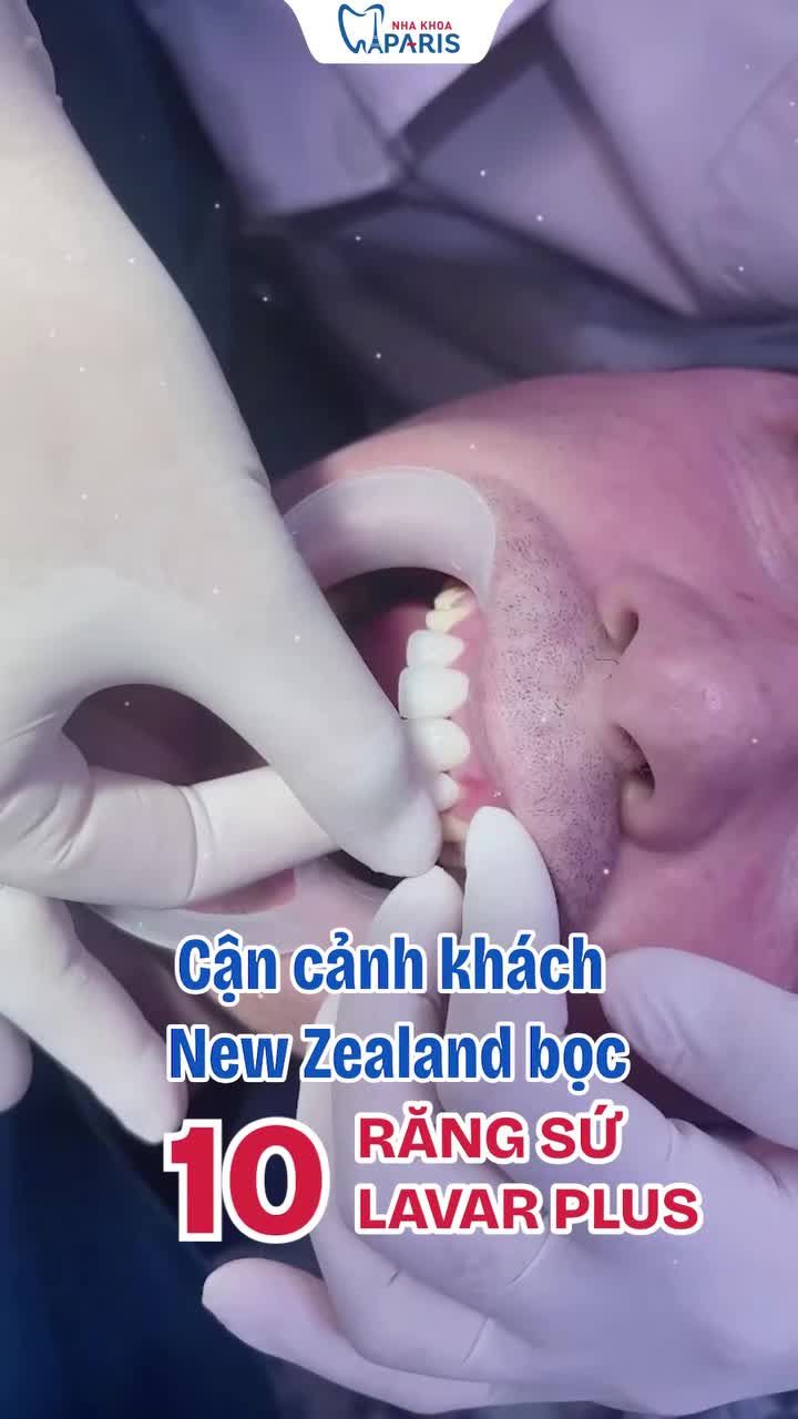 CẬN CẢNH NỤ CƯỜI 10 ĐIỂM CỦA ANH KHÁCH NEW ZEALAND BỌC 10 RĂNG SỨ LAVAR PLUS!