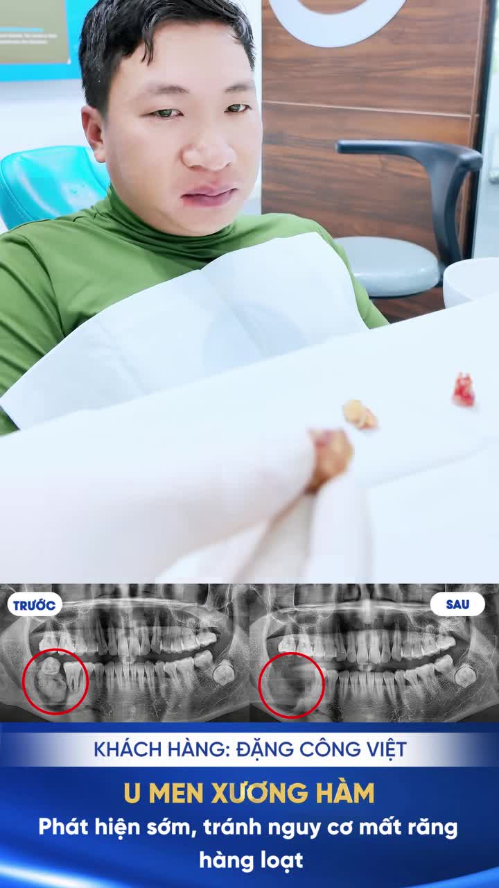 KHỐI U XƯƠNG HÀM ÂM THẦM TỪ CHIẾC RĂNG KHÔN: ĐỪNG ĐỂ QUÁ MUỘN!!!