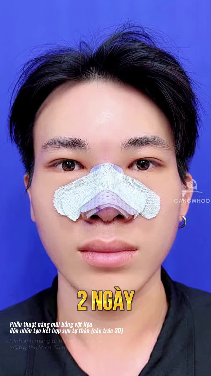 Hành trình 20 ngày nâng mũi thoát mác "boy mờ nhạt"