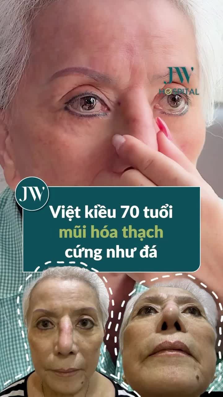 RÙNG MÌNH MŨI HÓA THẠCH CỨNG NHƯ ĐÁ SAU 20 NĂM NÂNG MŨI HỎNG, NỮ VIỆT KIỀU BAY GẤP VỀ NƯỚC CẦU CỨU BÁC SĨ TÚ DUNG