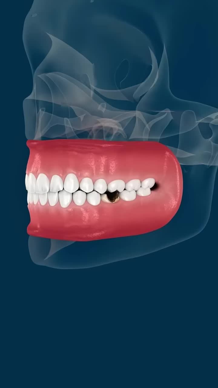 MẤT RĂNG SỐ 6 – NÊN NIỀNG RĂNG HAY TRỒNG IMPLANT
