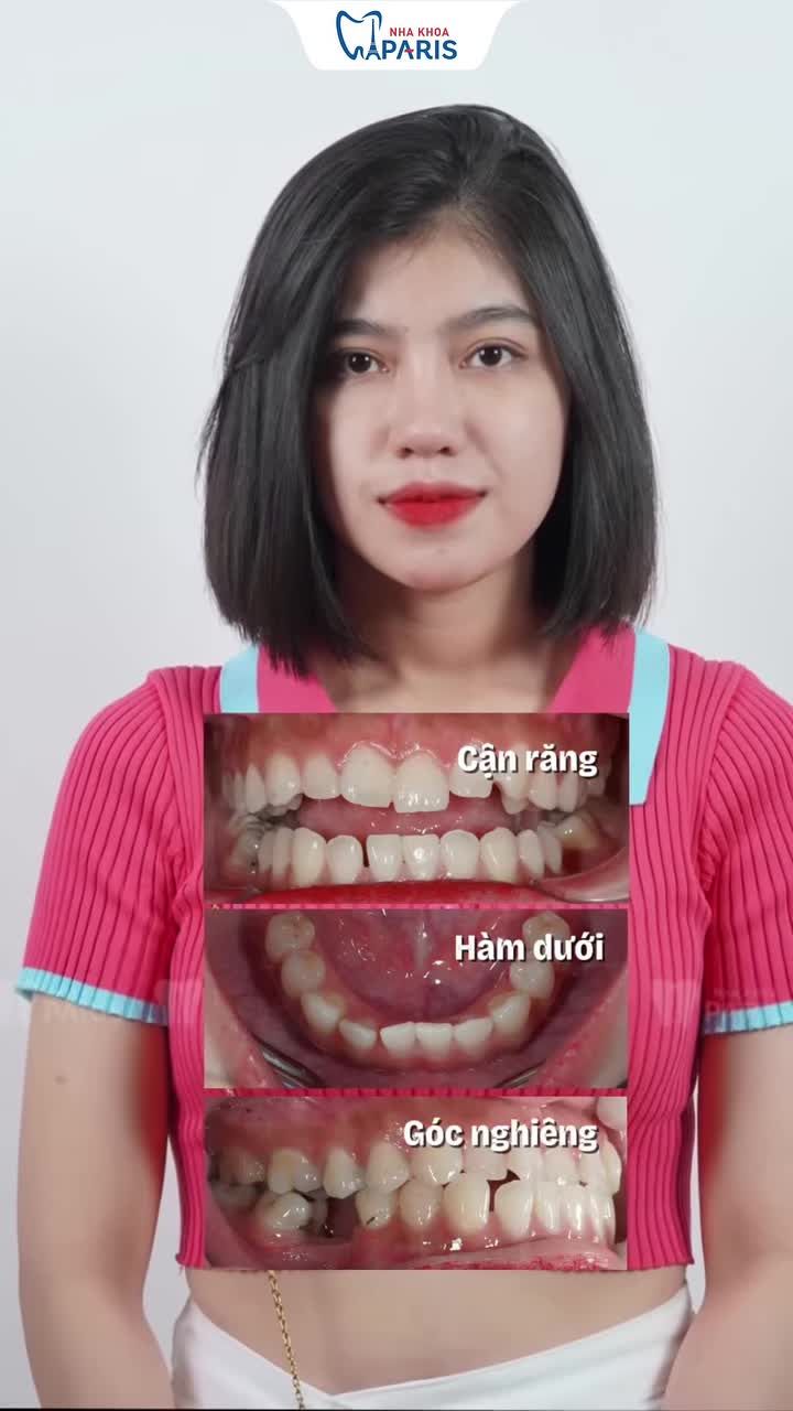 U30 NIỀNG RĂNG XONG LẤY CHỒNG LUÔN