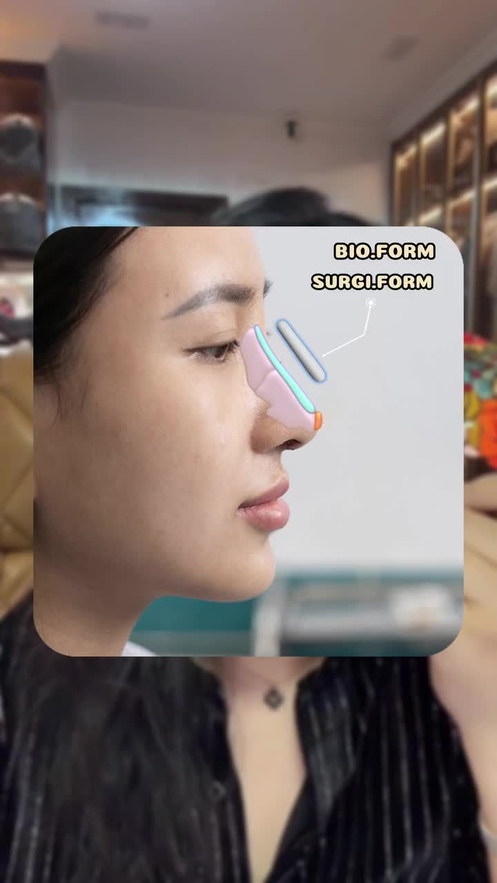 NÂNG MŨI THƯỜNG  - DÙNG SỤN SURGIFORM HAY BIOFORM CÓ ĐƯỢC KHÔNG?