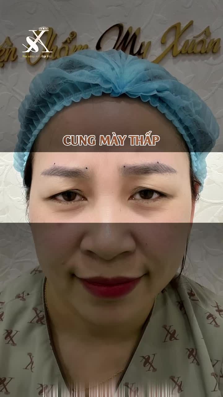 HÀNH TRÌNH TRẺ HÓA MẮT SỤP CỦA KHÁCH HÀNG U40