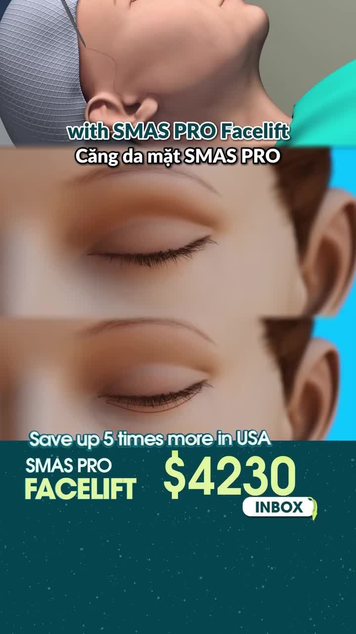U60 NGƯỜI ÚC TRẺ 20 TUỔI SAU 10 NGÀY CĂNG DA MẶT SMAS PRO, TRẺ HOÁ MẮT TẠI JW
