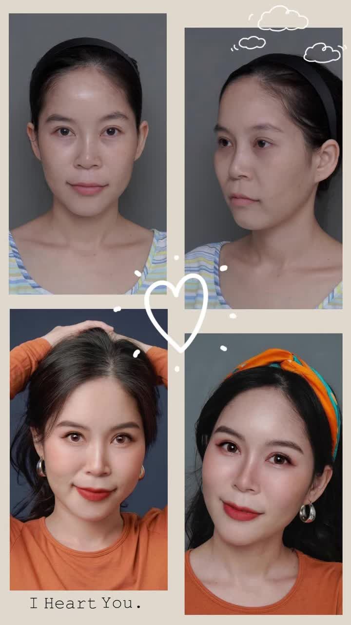 CẤY MỠ + TIÊM PROFHILO MANG LẠI SỰ TƯƠI TẮN CHO KHUÔN MẶT!