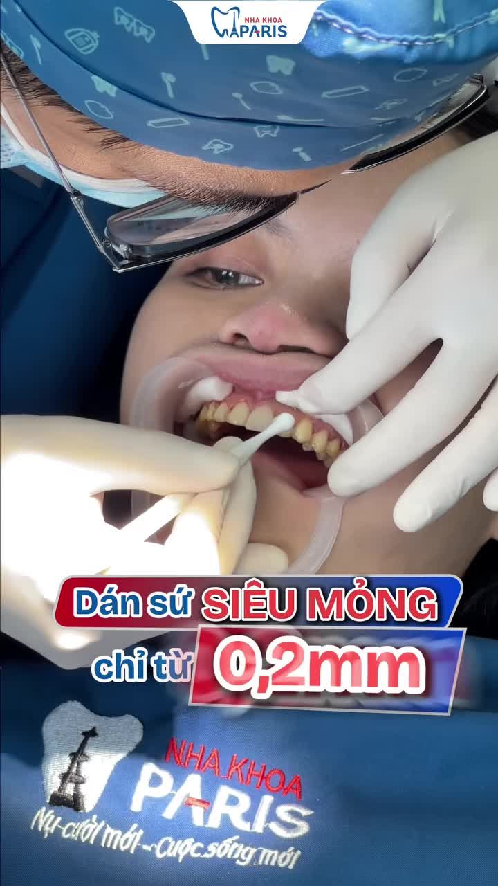 DÁN SỨ SIÊU MỎNG CHỈ TỪ 0,2MM