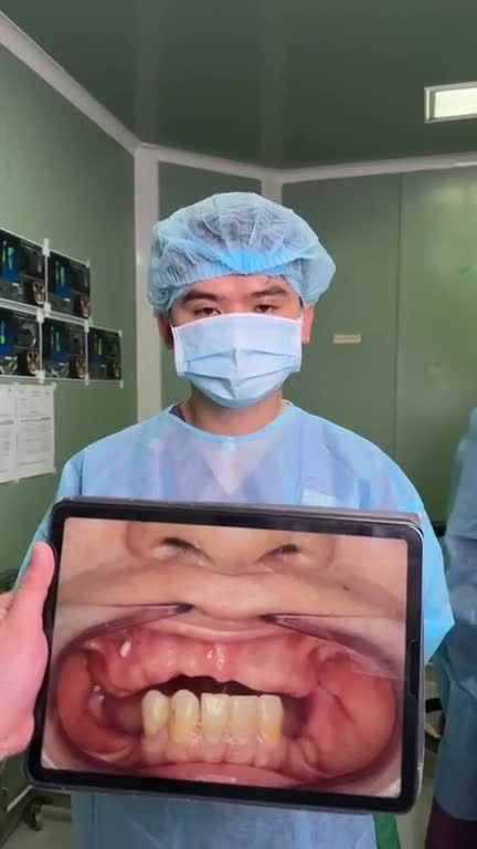 Quá trình TRỒNG RĂNG IMPLANT TOÀN HÀM cho Việt kiều mất răng lâu năm KHÔI PHỤC ĂN NHAI bền đẹp trọn đời