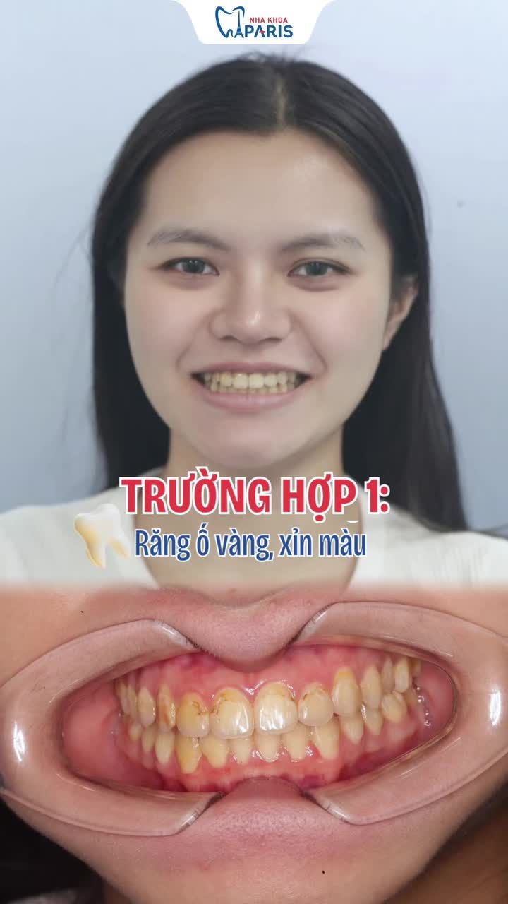 3 TRƯỜNG HỢP NÊN DÁN SỨ VENEER THẨM MỸ NGAY