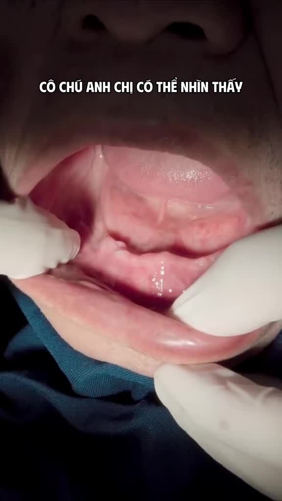 MẤT RĂNG KHÔNG ĐÁNG SỢ BẰNG ĐỂ MẤT RĂNG QUÁ LÂU