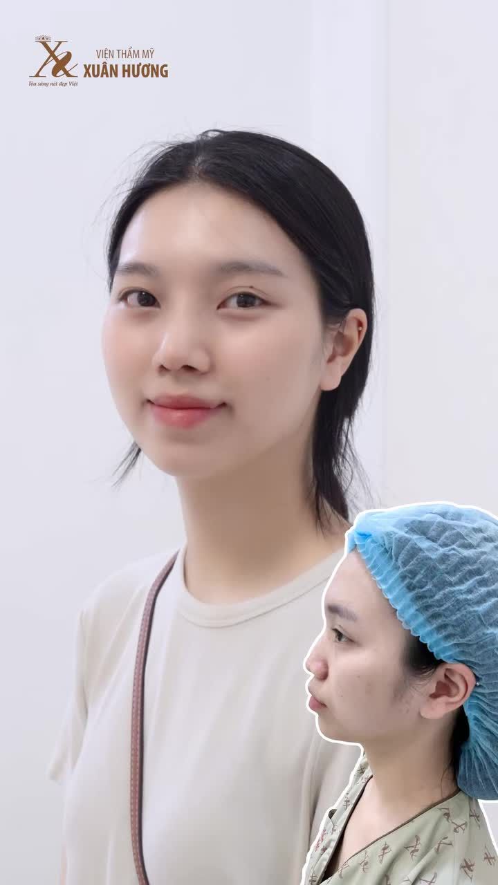 "Mũi trước đây của em không có sống mũi, phần mũi bị gãy và hơi gồ nên em quyết định nâng mũi..."