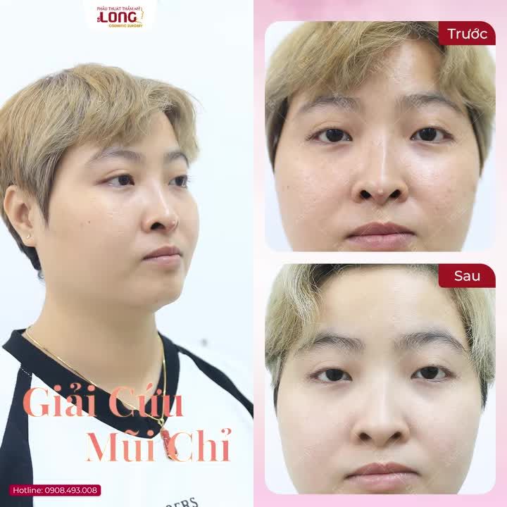 Mũi chỉ sưng, viêm và cách giải cứu giúp chiếc mũi an toàn.