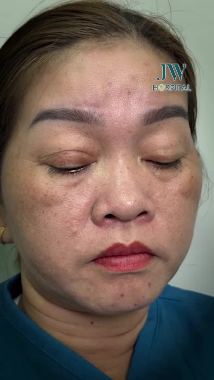 PHÉP MÀU: HƠN 20 NĂM NHÌN ĐỜI BẰNG 1 MẮT VÌ SỤP MI, NGƯỜI PHỤ NỮ U50 MIỀN TÂY VỠ ÒA KHI TÌM LẠI ĐƯỢC ÁNH SÁNG TẠI JW