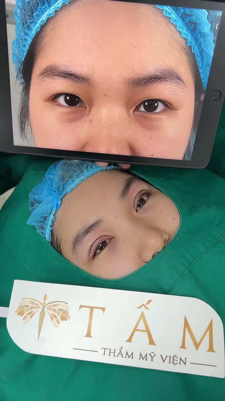 Hình ảnh khách hàng tại TMV sau 60 phút, đôi mắt sụp nhiều da dư ,có nếp mí phụ đã được “hô biến” thành đôi mắt hai mí to rõ, cân đối và trẻ trung hơn.