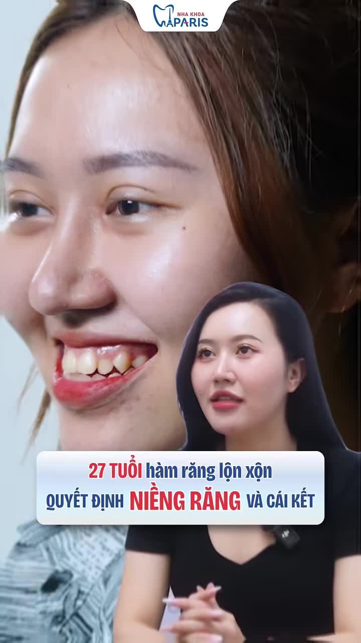 27 TUỔI, QUYẾT ĐỊNH NIỀNG RĂNG - MANG LẠI "CÁI KẾT" ĐẦY BẤT NGỜ!