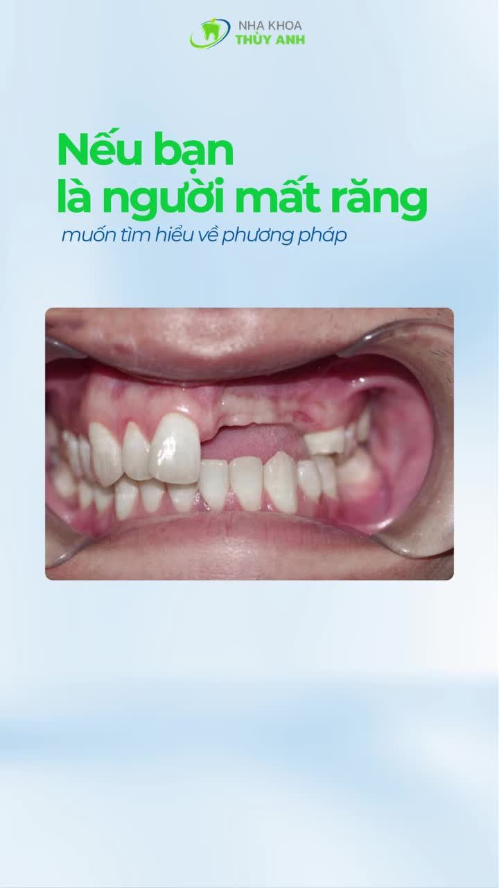 1 MILIMET: KHOẢNG CÁCH NHỎ TRÊN THƯỚC ĐO NHƯNG TẠO NÊN KHÁC BIỆT LỚN TRONG IMPLANT