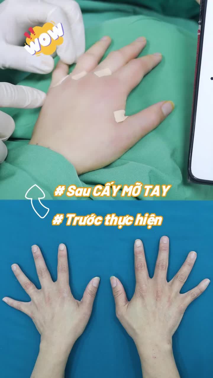 Bàn tay U50 mềm mại, nuột nà sau khi thực hiện CẤY MỠ BÀN TAY tại ekip Bác sĩ Lương Ngọc