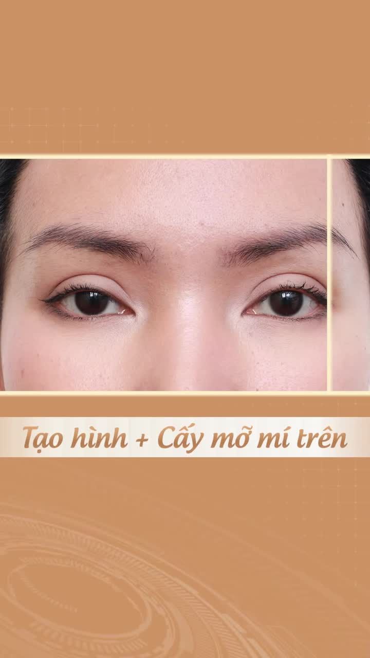Tái phẫu thuật mí mắt kết hợp cấy mỡ hốc mắt