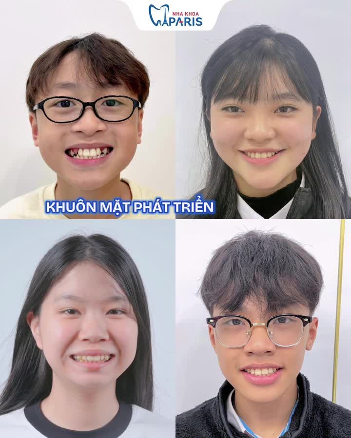 NIỀNG RĂNG SỚM CHO CON – ĐẦU TƯ NHỎ HÔM NAY, NỤ CƯỜI TỰ TIN MAI SAU