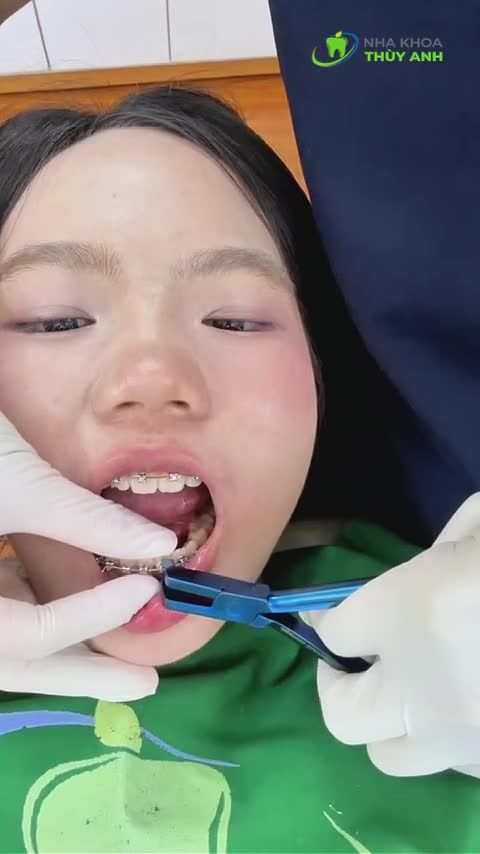 "Hôm nay anh chính thức được tháo niềng rồi các vợ iu ơi!"