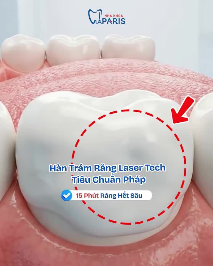 TRÁM RĂNG LASER TECH TIÊU CHUẨN PHÁP - ĂN NHAI HOÀN HẢO, THẨM MỸ TỐI ĐA