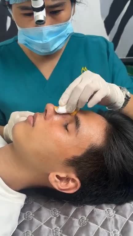 NÂNG MŨI CẤU TRÚC CHO NAM KẾT HỢP XỬ LÝ GỒ – KẾT QUẢ SAU 10 NGÀY ĐẸP ẤN TƯỢNG