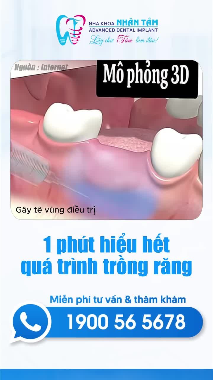 1 phút hiểu hết quy trình trồng răng Implant