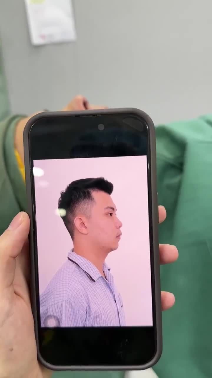 KẾT QUẢ NÂNG MŨI CẤU TRÚC CHO KHÁCH HÀNG NAM