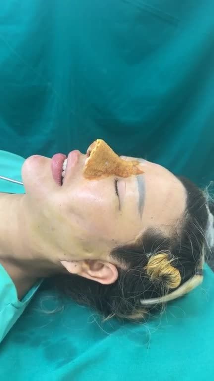 Case độn cằm vừa hoàn thành