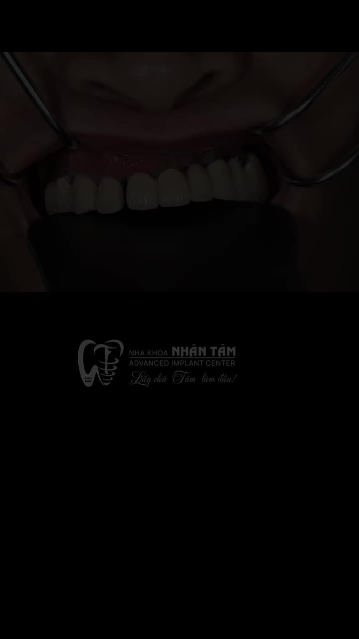 THAY ĐỔI DIỆU KỲ SAU CẤY GHÉP IMPLANT: “BIẾT THẾ NÀY CÔ ĐÃ LÀM SỚM HƠN!”
