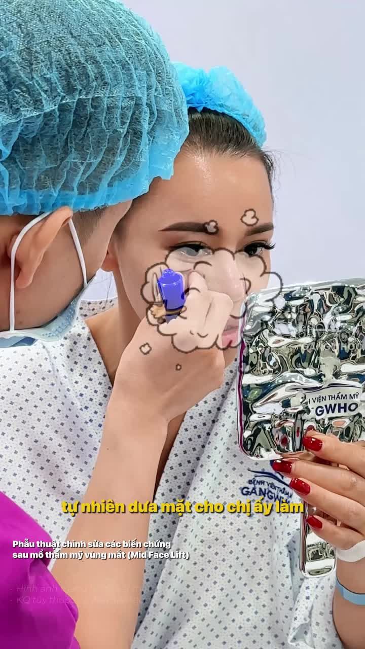 Giải cứu tình trạng xệ bờ mi dưới do can thiệp thẩm mỹ trước đó cho chị khách Việt kiều.