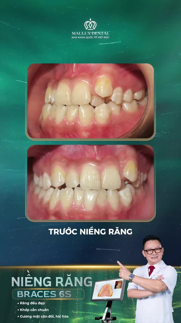 Niềng răng hết lệch mặt không cần phẫu thuật