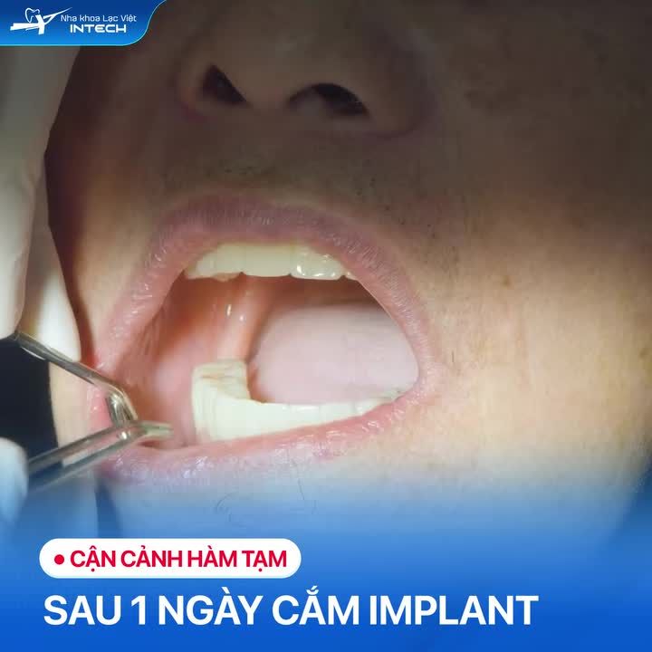 CẬN CẢNH HÀM TẠM SAU 1 NGÀY PHẪU THUẬT IMPLANT Ở BỆNH NHÂN MẤT RĂNG LÂU NĂM KÈM BỆNH LÝ TIM MẠCH