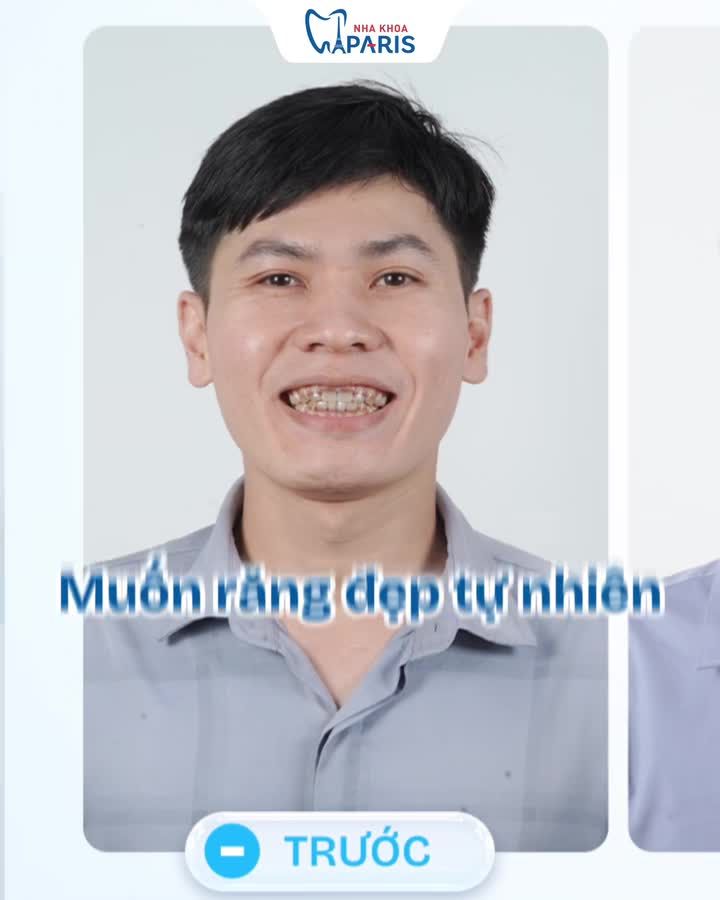"ỦA, LÀM RĂNG SỨ MÀ TỰ NHIÊN NHƯ RĂNG THẬT VẬY SAO?