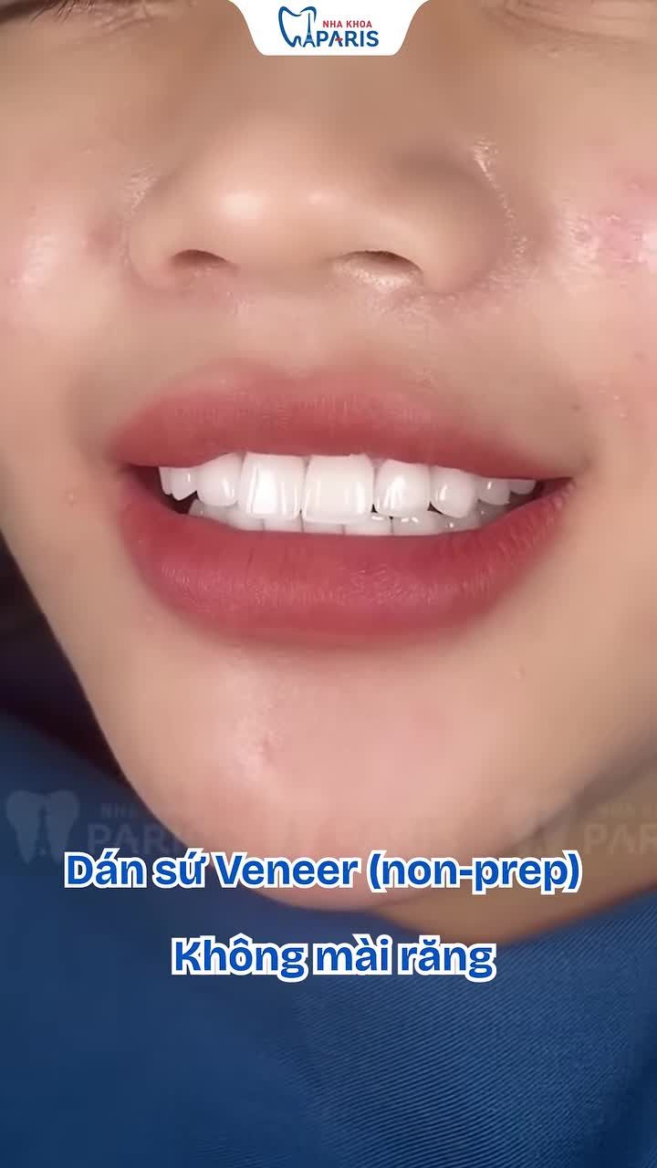 VENEER NON-PREP: THẨM MỸ RĂNG SỨ CỦA TƯƠNG LAI – "KHÔNG MÀI RĂNG, BẢO TỒN NGUYÊN GỐC"