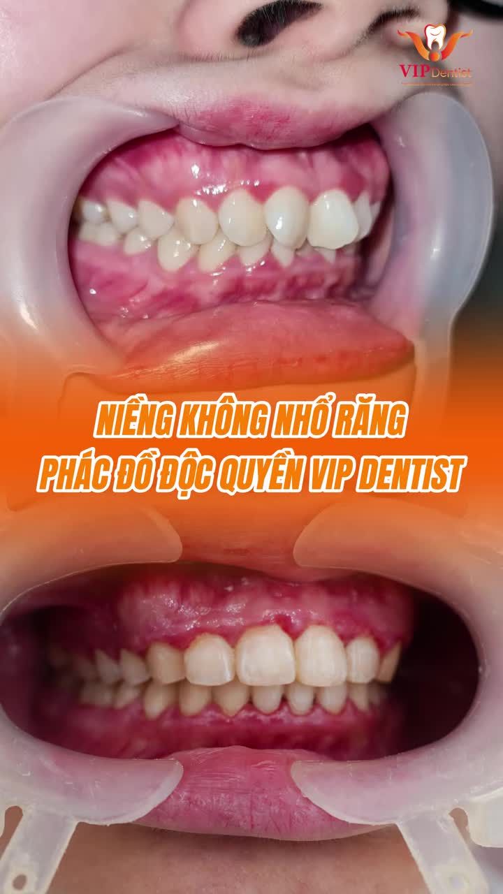 Niềng răng không nhổ răng - giải pháp giúp răng đều đẹp, tối ưu bảo tồn răng gốc, nhẹ nhàng, và hiệu quả!