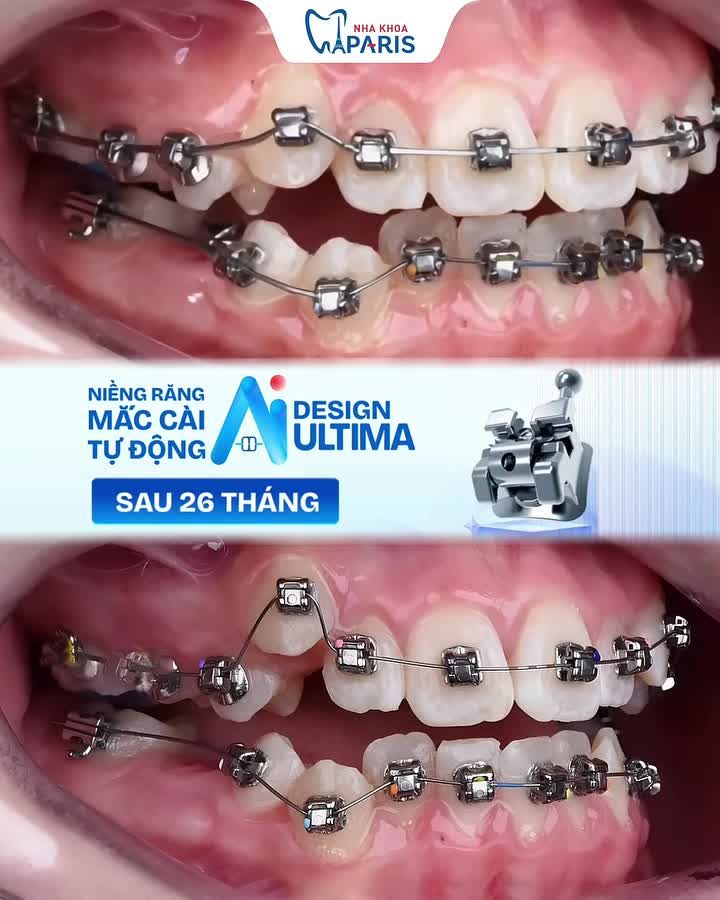 SỰ KỲ DIỆU CỦA CHỈNH NHA: "LỘT XÁC" THẦN THÁI CHỈ SAU 26 THÁNG!