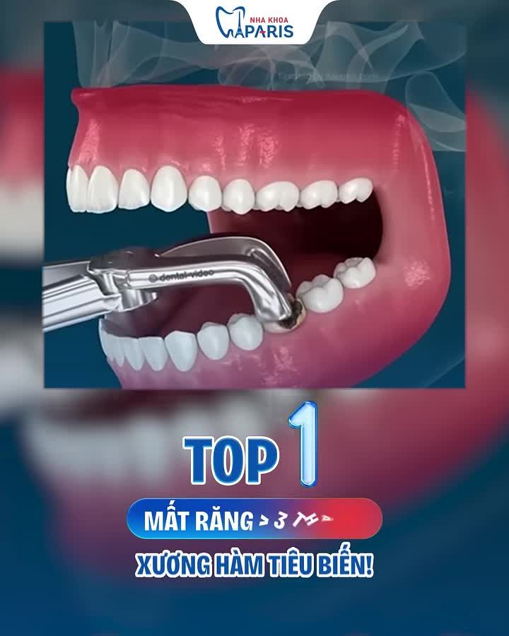 TOP 3 DẤU HIỆU CẢNH BÁO ĐÃ ĐẾN LÚC TRỒNG RĂNG NGAY!
