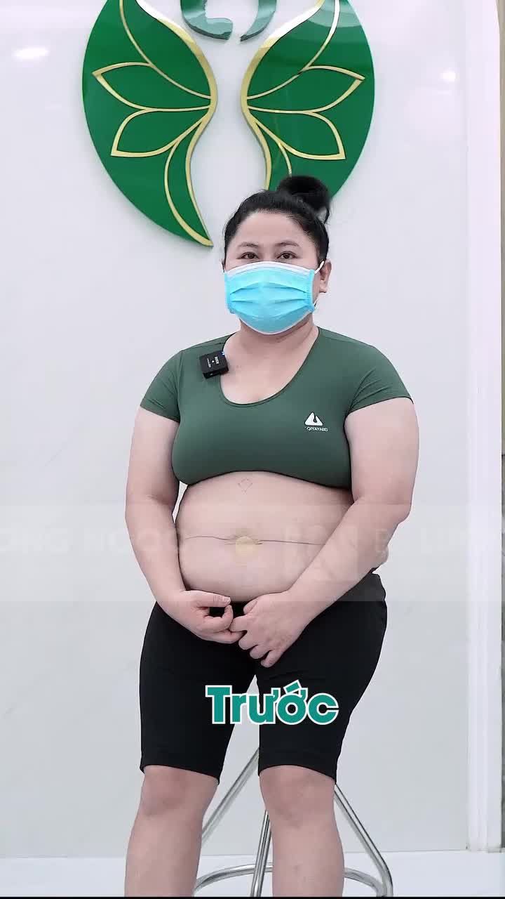 Cái kết của vòng bụng "khủng" 119cm !