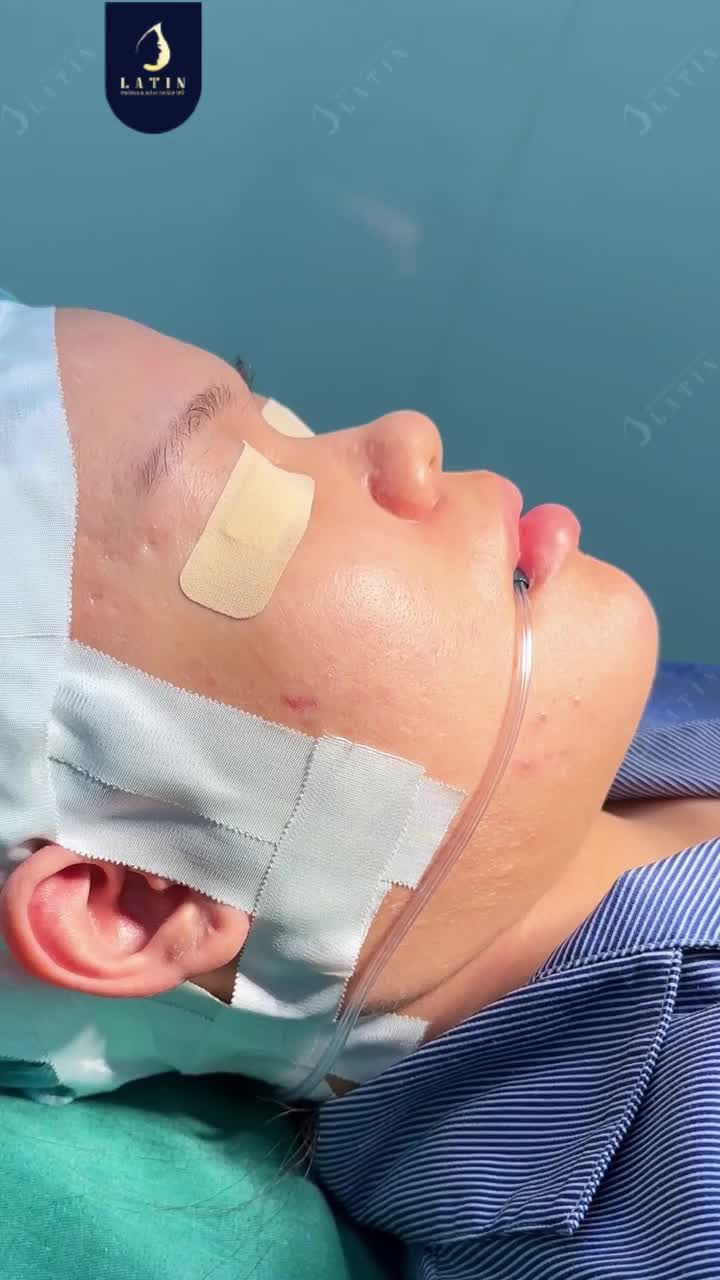 DÁNG MŨI TỰ NHIÊN – GÓC NGHIÊNG CUỐN HÚT