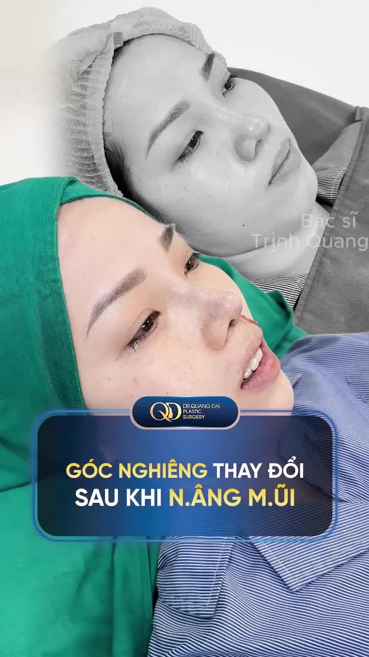GÓC NGHIÊNG THAY ĐỔI SAU KHI NÂNG MŨI
