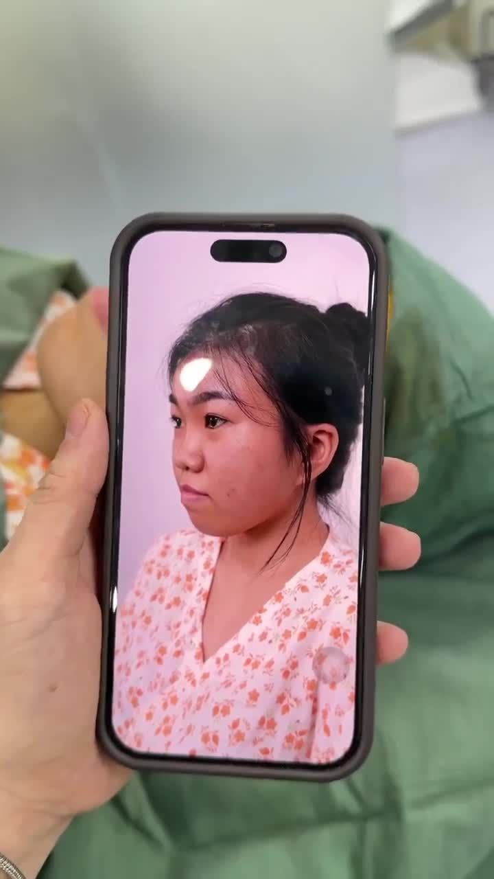 TRẢ KẾT QUẢ NÂNG MŨI CẤU TRÚC DR. HOẠT KH: LAN THANH (ĐỒNG THÁP)