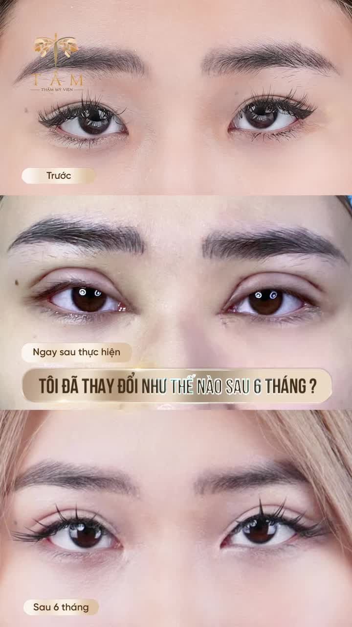 Sau 6 tháng CẮT MÍ tại Tấm, cô bạn đã thay đổi như nào? Cùng đón xem và lắng nghe chia sẻ nha!