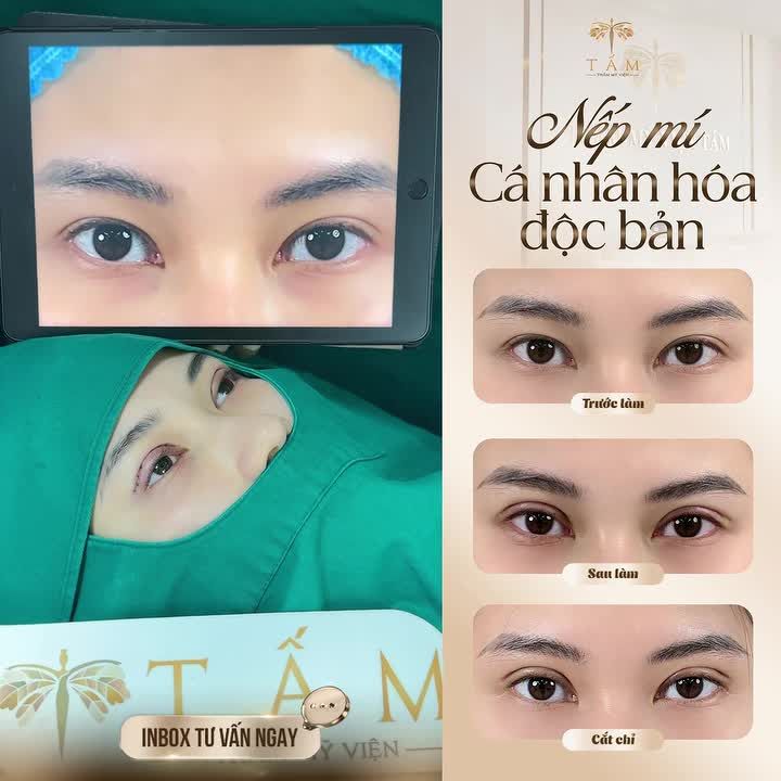 Sự thay đổi hoàn toàn của đôi mắt THIẾU MỠ, 2 MÍ KHÔNG ĐỀU ngay sau vừa CẮT MÍ tại Tấm!