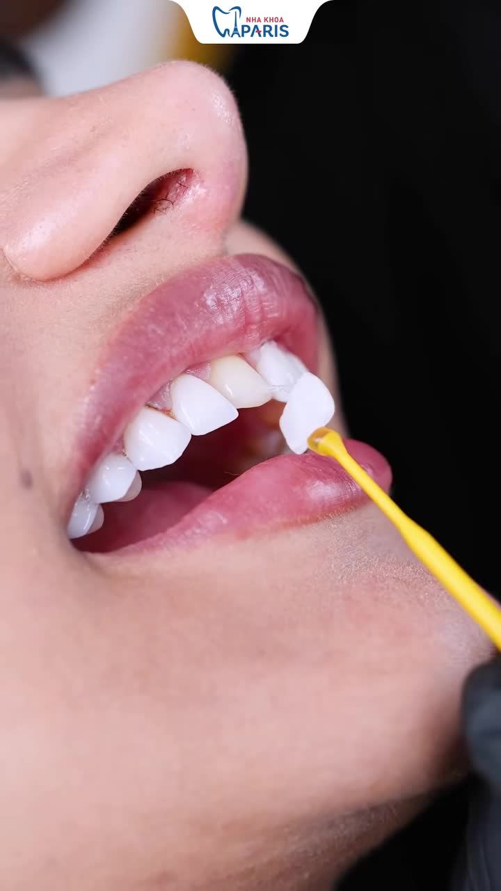 DÁN SỨ VENEER NON-PREP – GIẢI PHÁP TÁI TẠO NỤ CƯỜI TRẮNG SÁNG TỰ NHIÊN